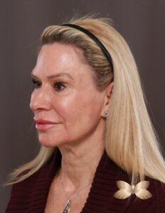 Facelift, Browlift, Lower Blepharoplasty with Fat Grafting by Dr. Thompson
