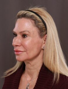 Facelift, Browlift, Lower Blepharoplasty with Fat Grafting by Dr. Thompson