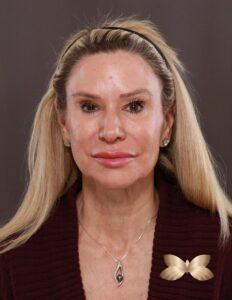 Facelift, Browlift, Lower Blepharoplasty with Fat Grafting by Dr. Thompson