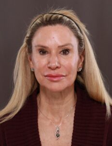 Facelift, Browlift, Lower Blepharoplasty with Fat Grafting by Dr. Thompson