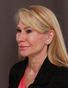 Facelift, Browlift, Lower Blepharoplasty with Fat Grafting by Dr. Thompson