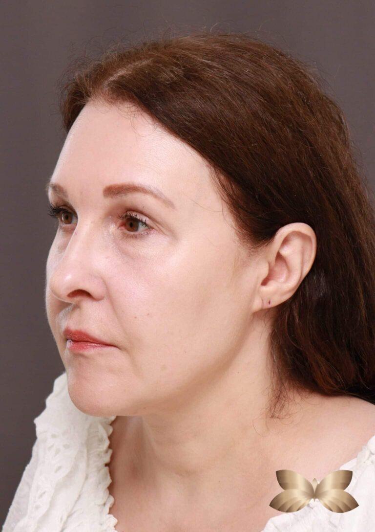 Before Image: Macslift, Lower Blepharoplasty, Periorbital Fat Grafting by Dr. Henstrom -