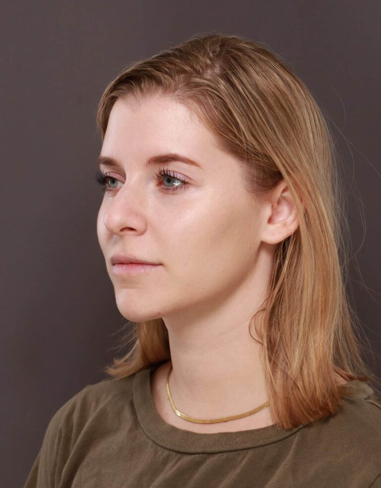 Before Image: Rhinoplasty by Dr. Henstrom - left-front-oblique