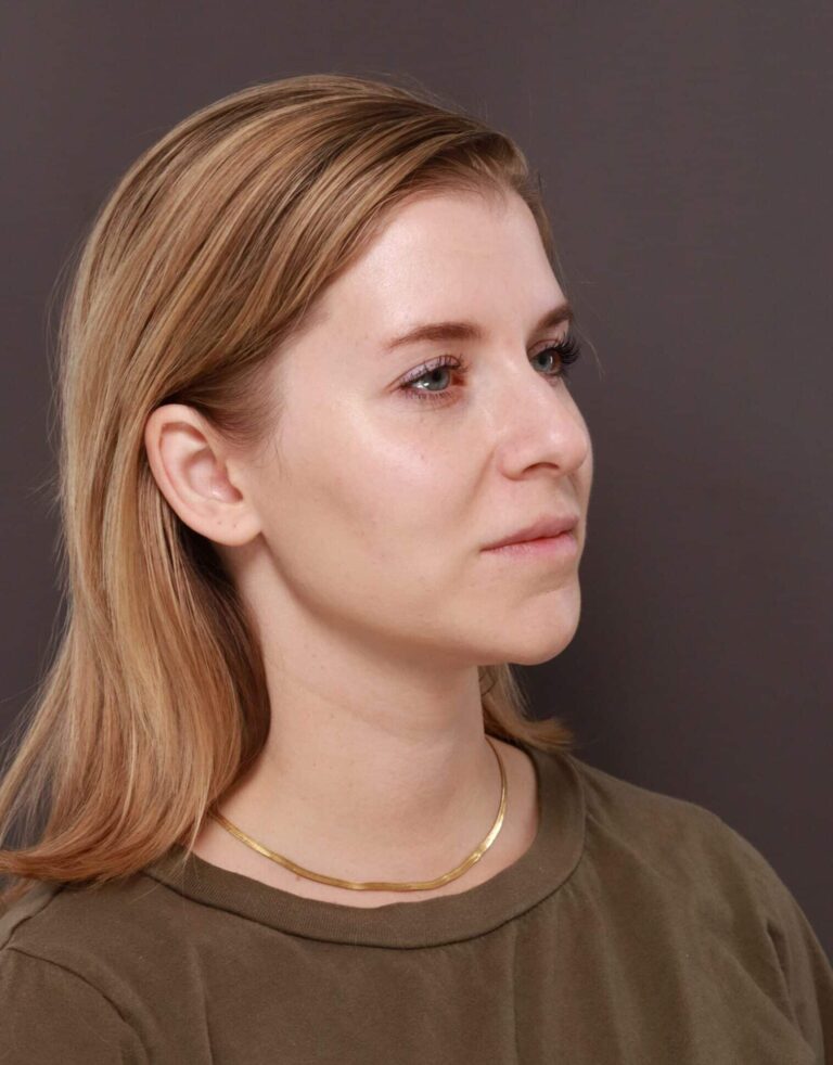 Before Image: Rhinoplasty by Dr. Henstrom -