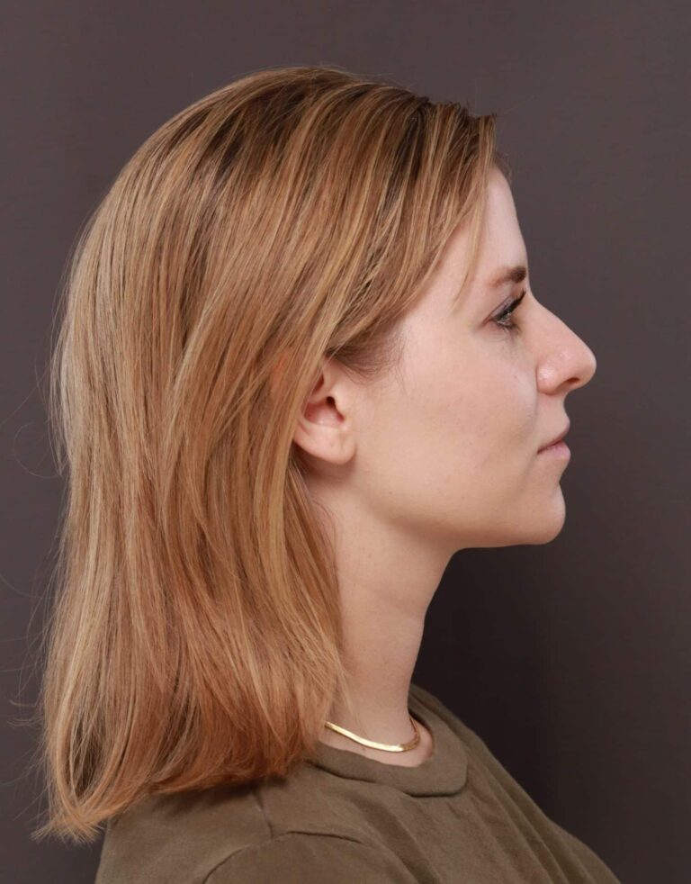 Before Image: Rhinoplasty by Dr. Henstrom -