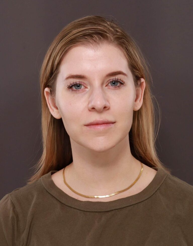 Before Image: Rhinoplasty by Dr. Henstrom - front