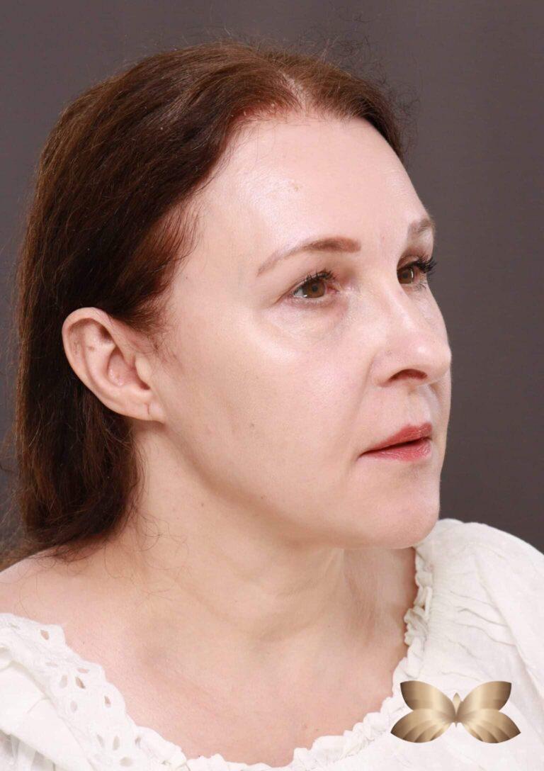 Before Image: Macslift, Lower Blepharoplasty, Periorbital Fat Grafting by Dr. Henstrom -