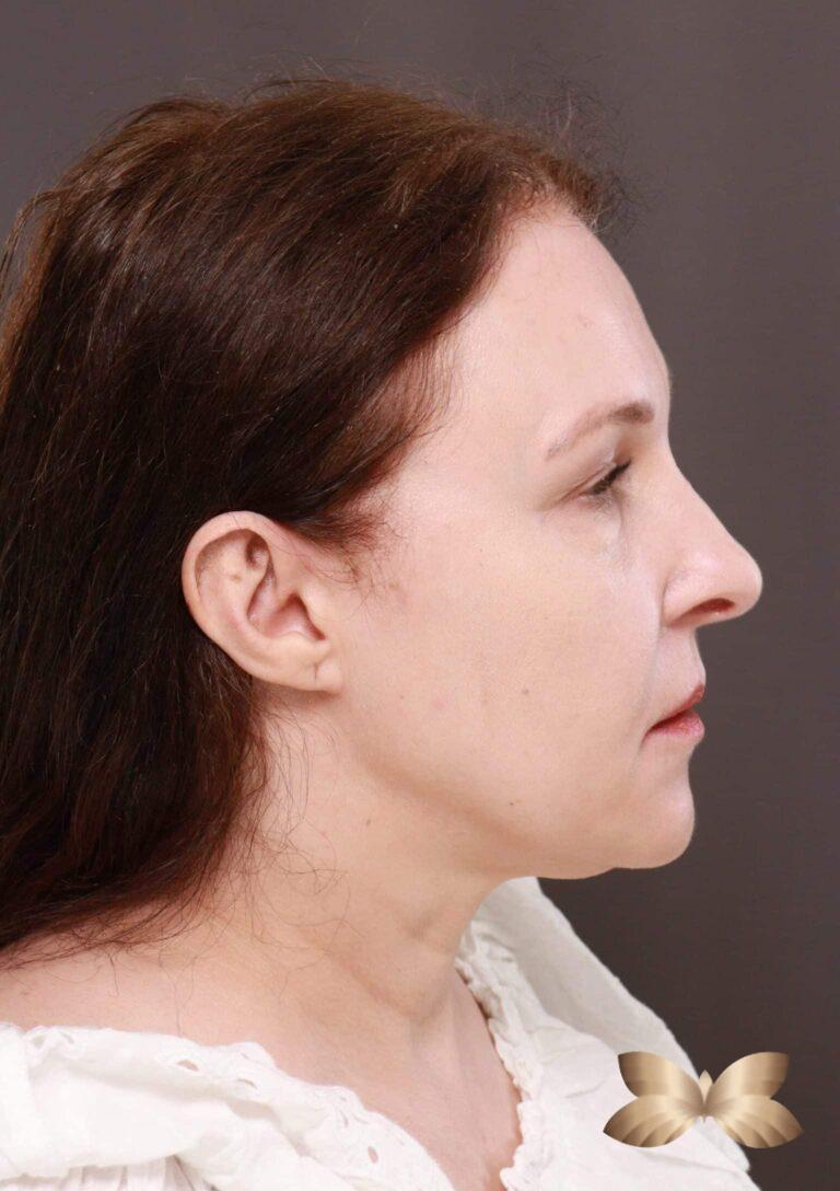 Before Image: Macslift, Lower Blepharoplasty, Periorbital Fat Grafting by Dr. Henstrom - right-side