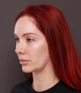 Deep Neck Contouring with Chin Implant Revision by Dr. Manning