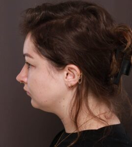 Deep Neck Contouring with Chin Implant by Dr. Manning