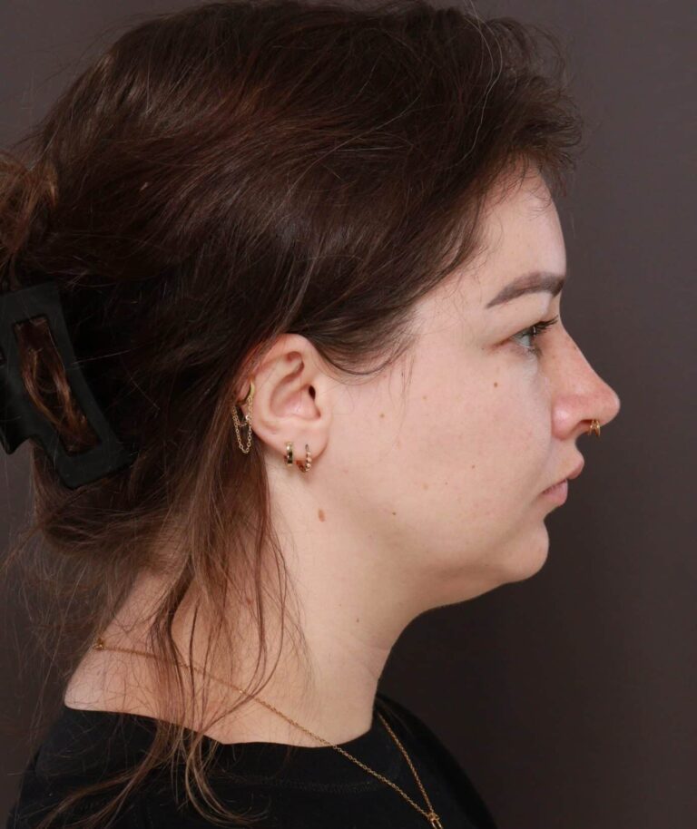 Before Image: Deep Neck Contouring with Chin Implant by Dr. Manning - right-side