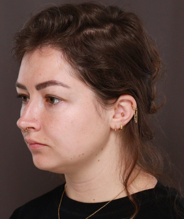 Before Image: Deep Neck Contouring with Chin Implant by Dr. Manning - left-front-oblique