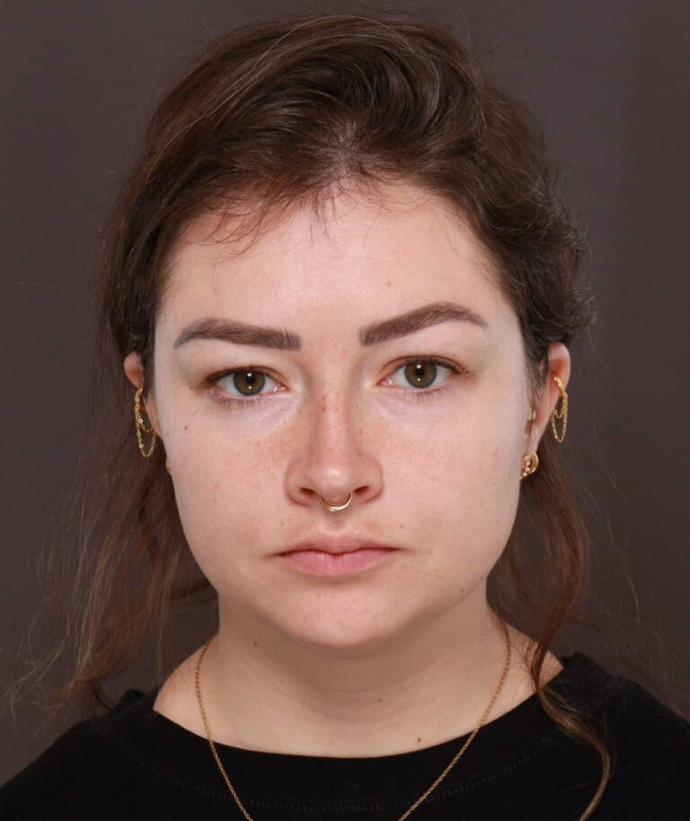 Before Image: Deep Neck Contouring with Chin Implant by Dr. Manning - front