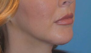 Chin Implant