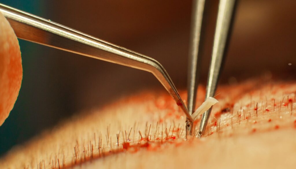 FUE Hair Transplant