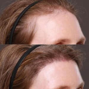 Nonsurgical forhead tx