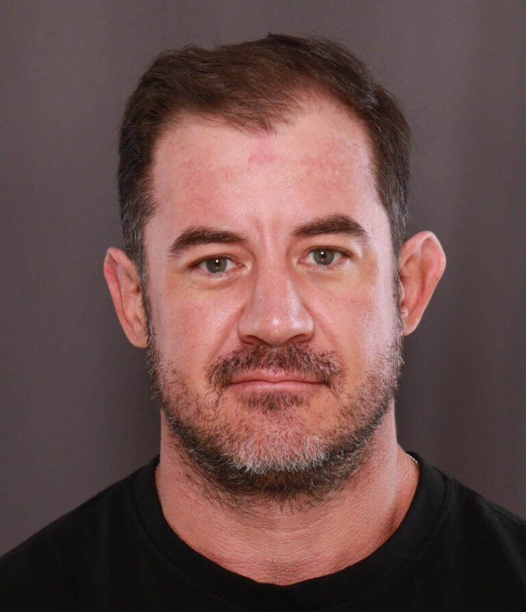 Before Image: Otoplasty by Dr. Manning - front