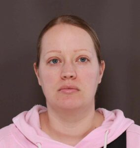 Upper Blepharoplasty & Lower Blepharoplasty with Periorbital Fat Transfer by Dr. Manning