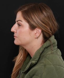 Septorhinoplasty by Dr. Henstrom