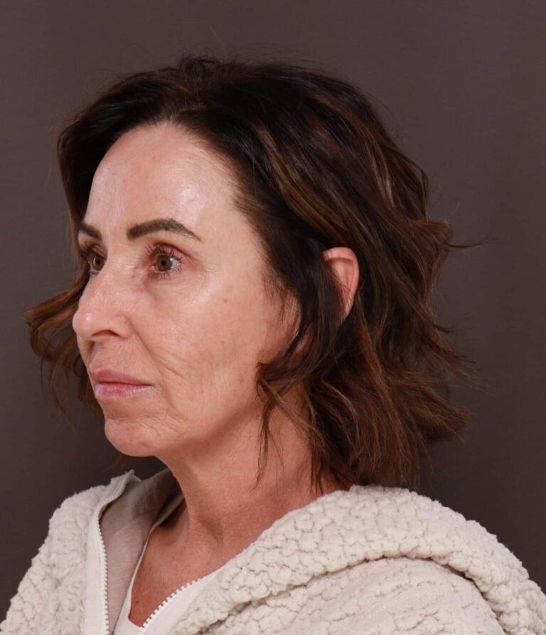 After Image: Chin Implant by Dr. Thompson - left-front-oblique