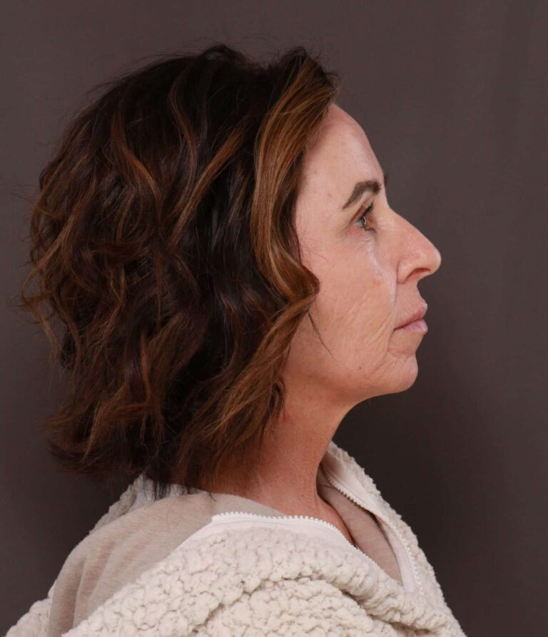 After Image: Chin Implant by Dr. Thompson - right-side