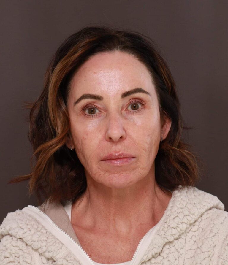 After Image: Chin Implant by Dr. Thompson - front