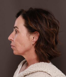 Chin Implant by Dr. Thompson