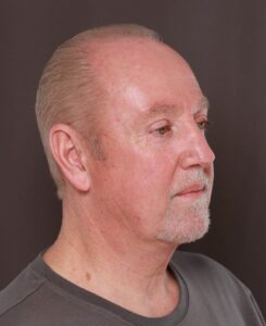 Direct Necklift with Upper & Lower Blepharoplasty by Dr. Henstrom