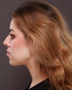 Dermal Fillers to Lips and Chin