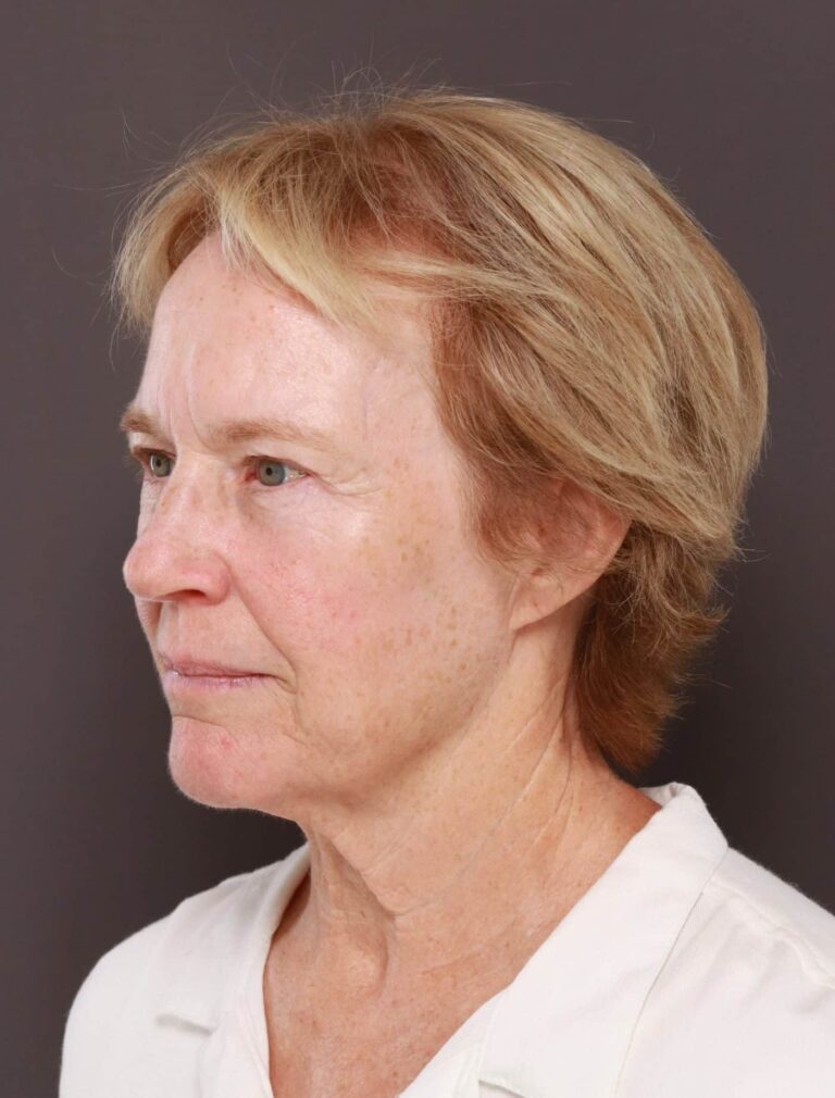 Before Image: Direct Neck Lift by Dr. Henstrom - left-front-oblique