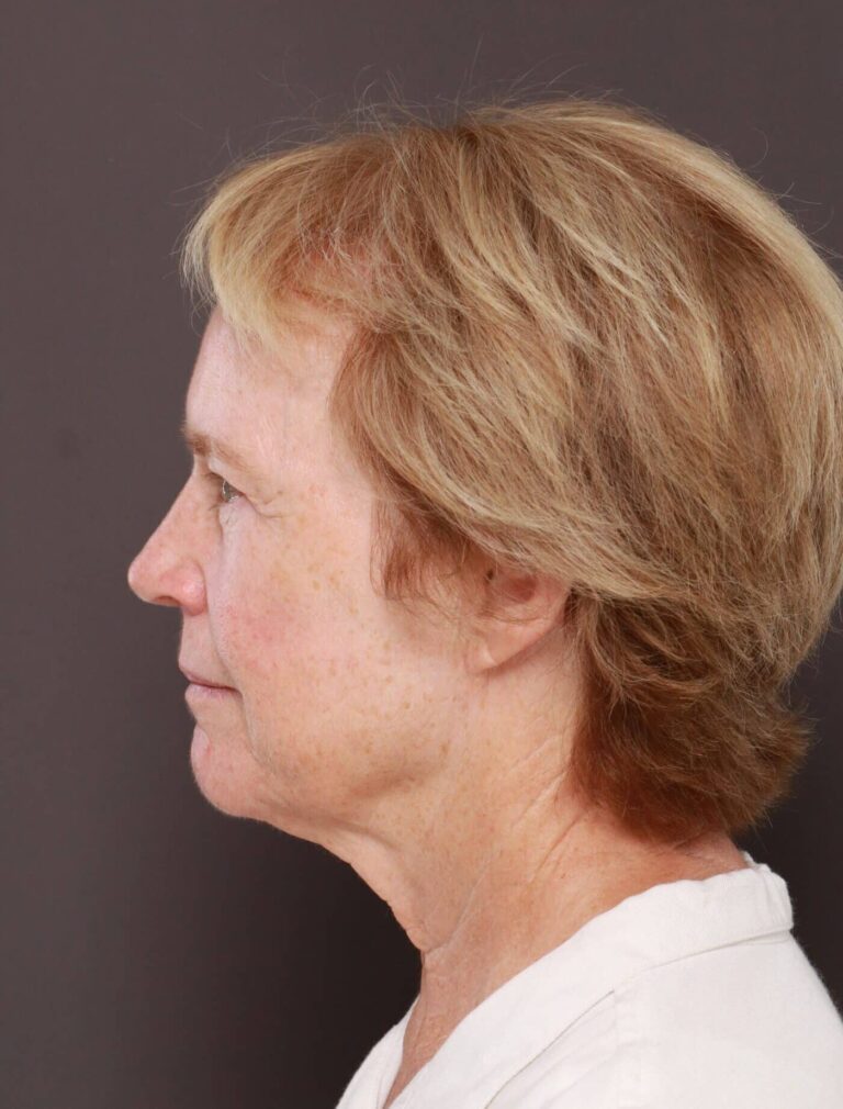 Before Image: Direct Neck Lift by Dr. Henstrom - left-side