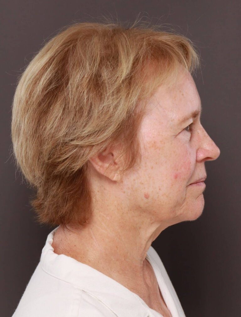 Before Image: Direct Neck Lift by Dr. Henstrom - right-side
