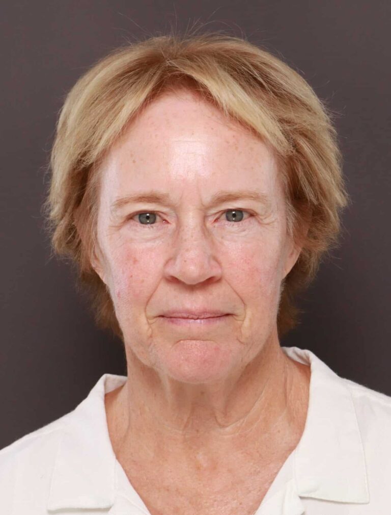 Before Image: Direct Neck Lift by Dr. Henstrom - front