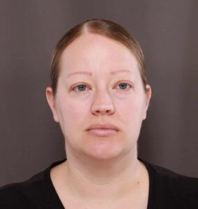 Upper Blepharoplasty & Lower Blepharoplasty with Periorbital Fat Transfer by Dr. Manning