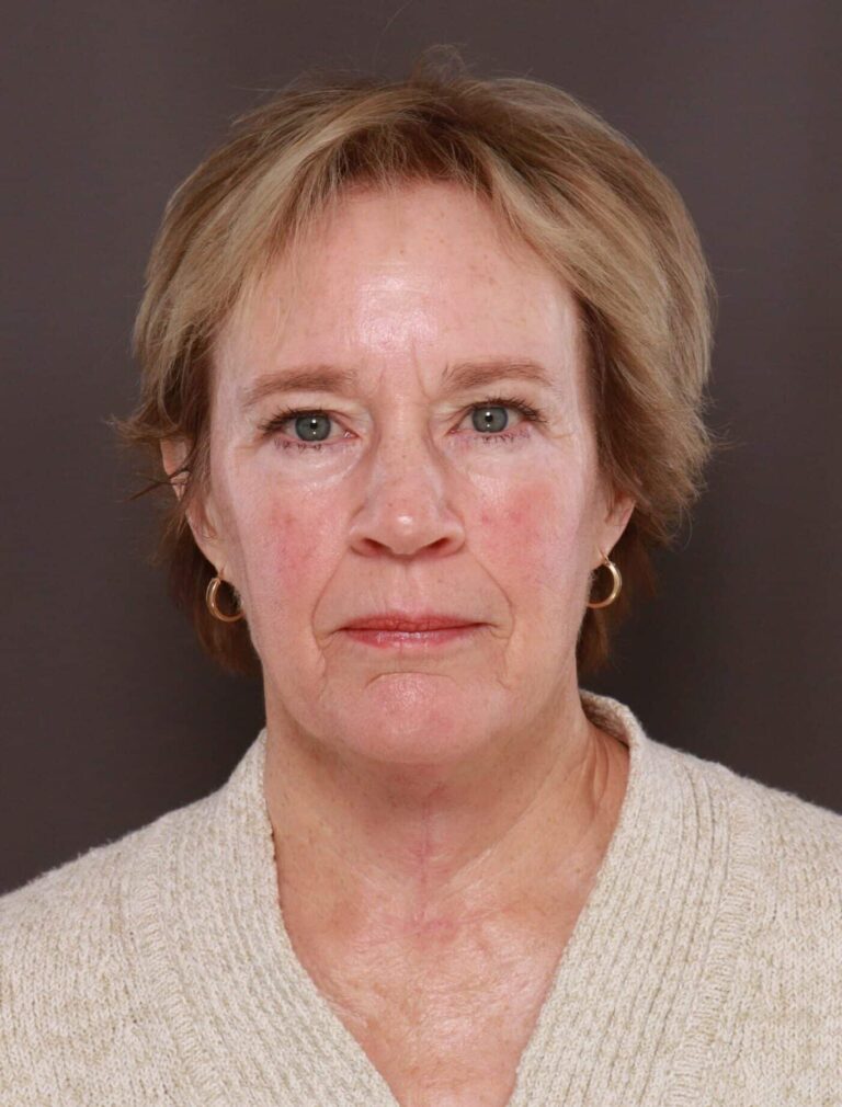 After Image: Direct Neck Lift by Dr. Henstrom - front