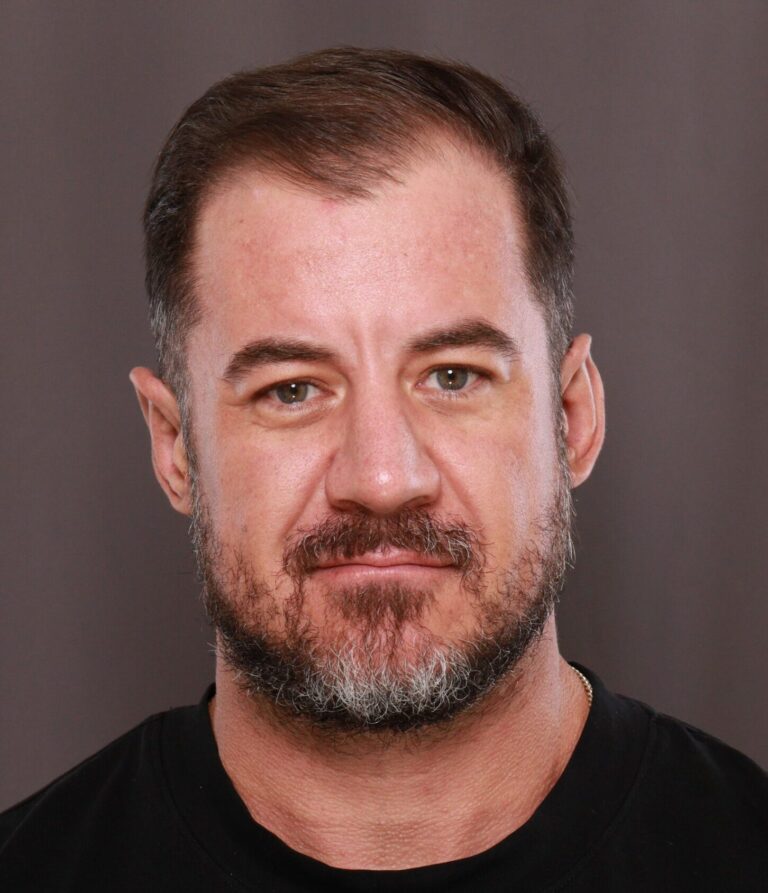 After Image: Otoplasty by Dr. Manning - front