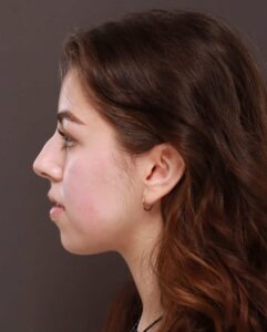 Dermal Fillers to Lips and Chin