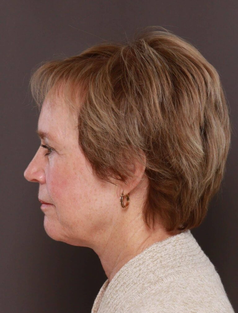 After Image: Direct Neck Lift by Dr. Henstrom - left-side