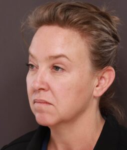 Facelift, Deep Neck Contouring, & Pre Jowl Chin Implant by Dr. Thompson