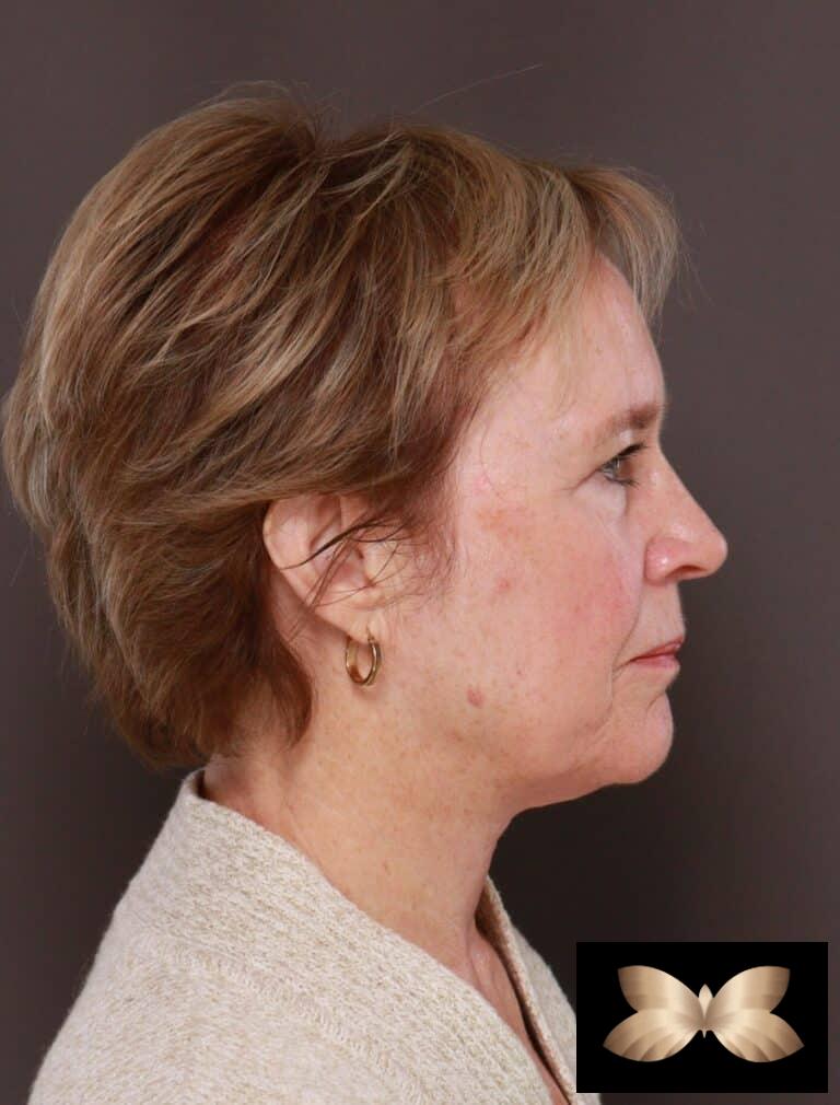 After Image: Direct Neck Lift by Dr. Henstrom - right-side