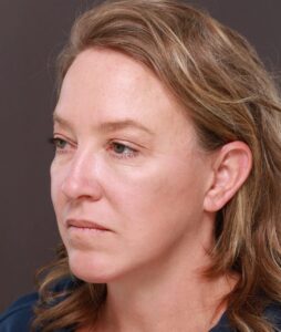 Facelift, Deep Neck Contouring, & Pre Jowl Chin Implant by Dr. Thompson