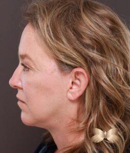 Facelift, Deep Neck Contouring, & Pre Jowl Chin Implant by Dr. Thompson
