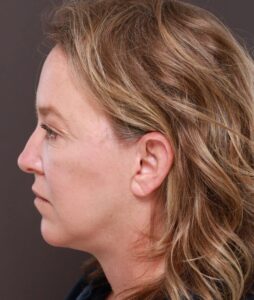 Facelift, Deep Neck Contouring, & Pre Jowl Chin Implant by Dr. Thompson