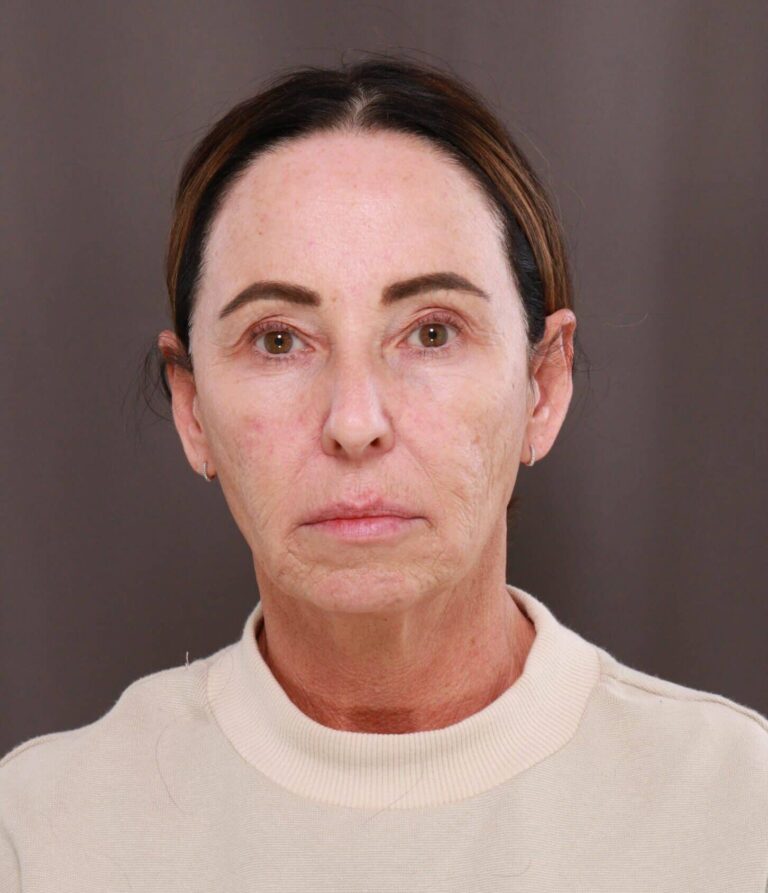 Before Image: Chin Implant by Dr. Thompson - front