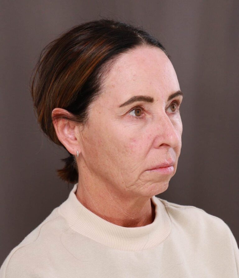 Before Image: Chin Implant by Dr. Thompson - right-front-oblique