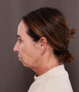 Chin Implant by Dr. Thompson