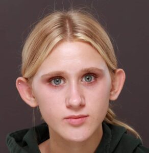 Otoplasty by Dr. Manning