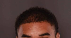 FUE Hair Transplant by Dr. Manning