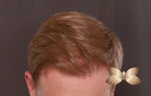 FUE Hair Transplant by Dr, Henstrom