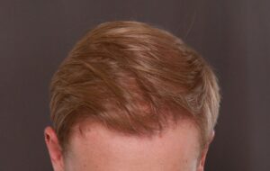 FUE Hair Transplant by Dr, Henstrom